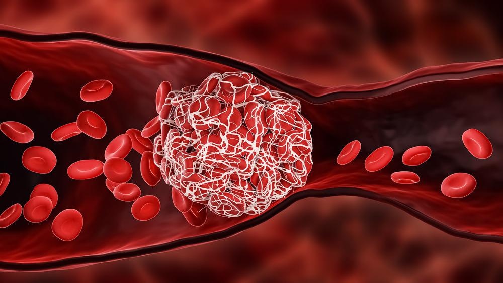 The Role of Blood Clot Sensors in Medical Treatment and Diagnostics