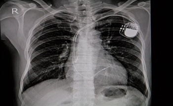 A History Of Pacemakers