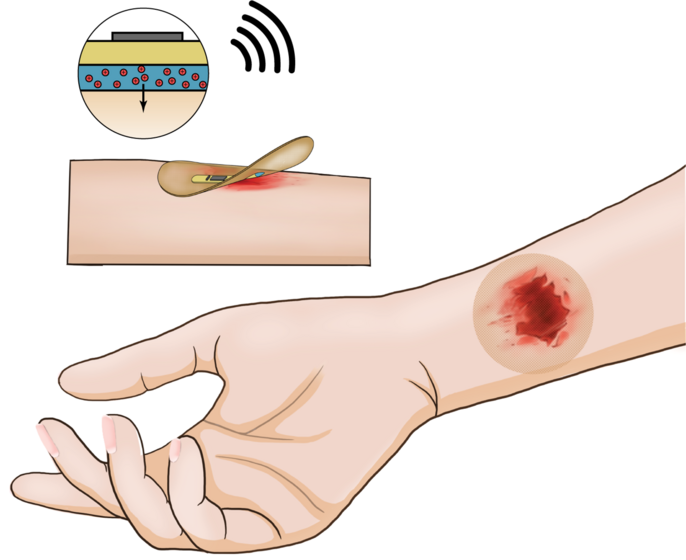 Wireless Bandage for Stimulating Chronic Wound Healing