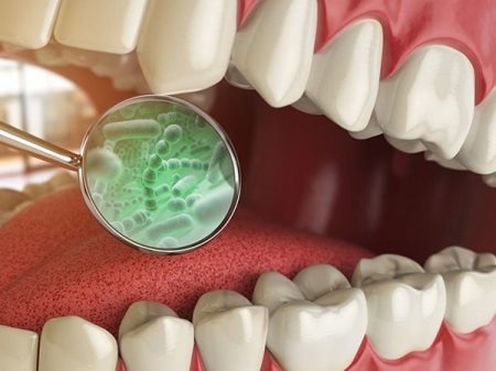 Using an Enhanced Electronic Tongue for Dental Bacterial Discrimination