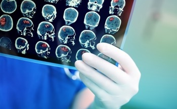 Diagnosing Brain Cancer With Just a Small Blood Sample